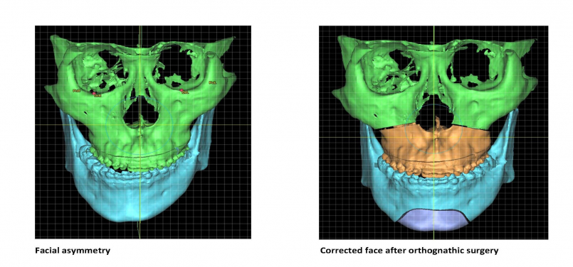 Corrected face after orthognathic surgery